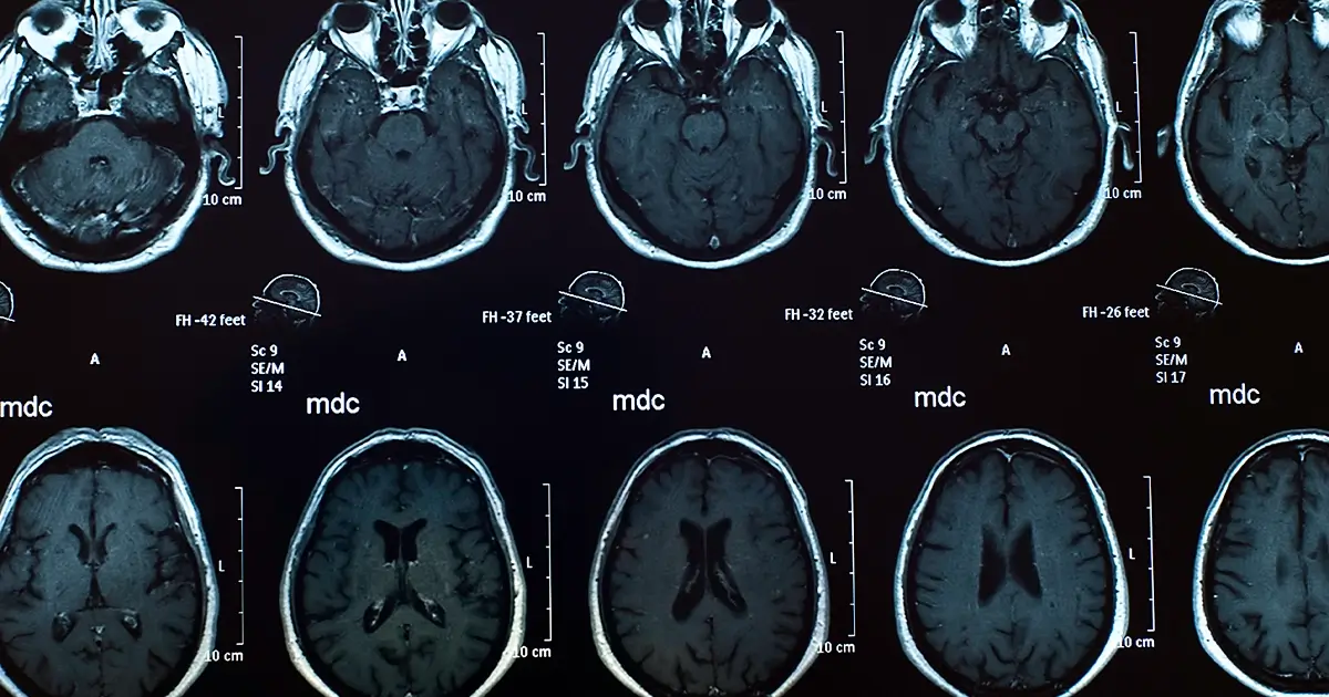 Traumatic Brain Injuries