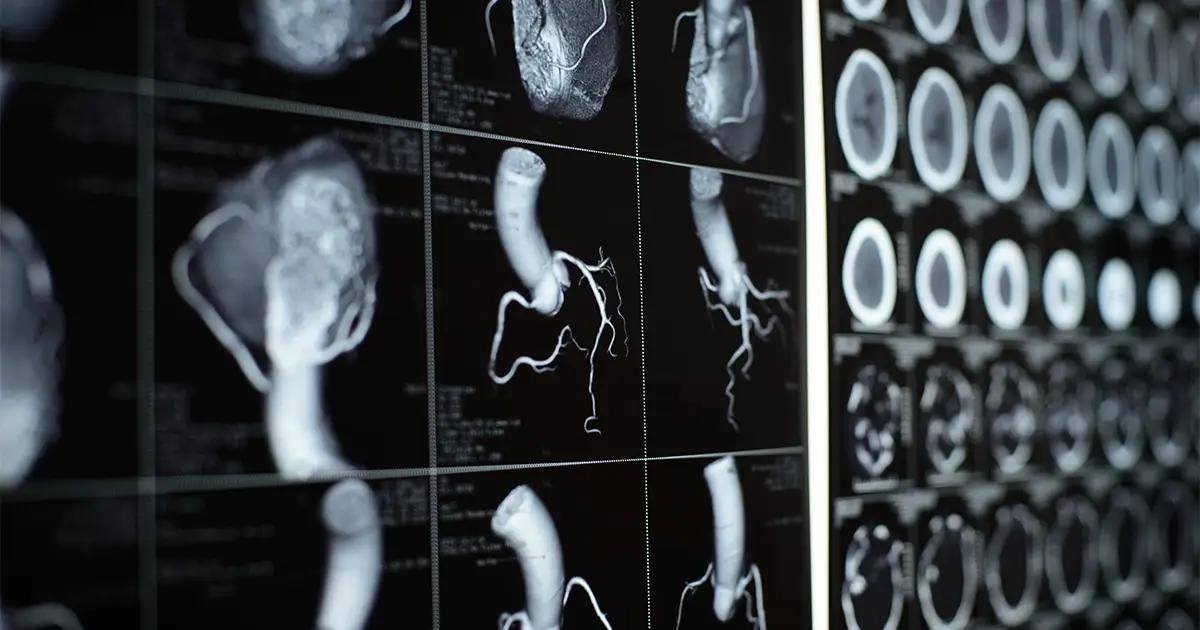IVC Filter Lawsuit