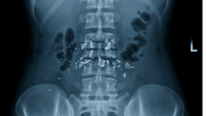 Back Injuries from Lifting Packages: FedEx’s Safety Obligations in Tampa Bay