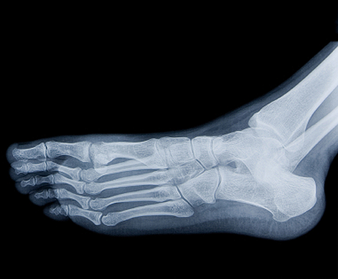 ankle-xray