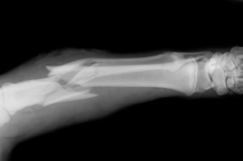 broken-bone