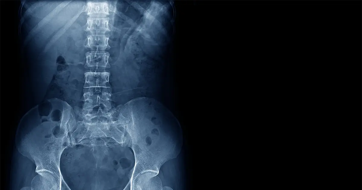 Herniated Disk Injuries