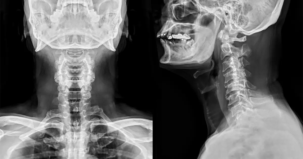 Spinal Cord Injuries